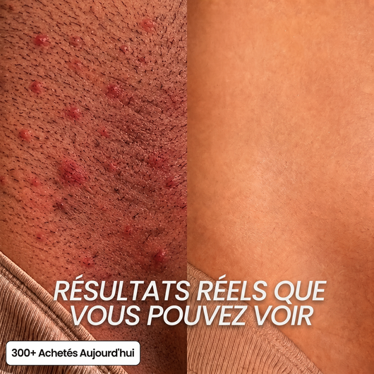 Huile au Cyperus | Repousse Ralentie & Peau Apaisée